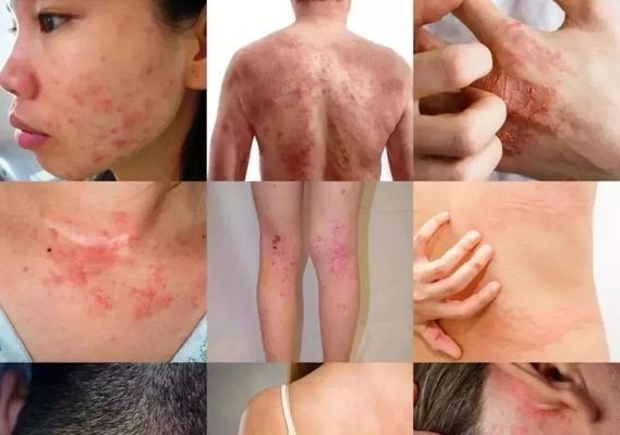 浅析板栗树落果的原因（从环境、营养、病虫害等多个角度探究板栗树落果的成因）